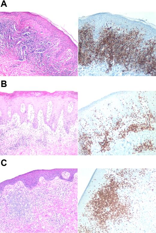 Figure 7. Histologic and immunophenotypical correlation with cluster. Representative biopsies are shown. Left panels are the hematoxylin-eosin stain, and right panels are immunohistochemical stains using monoclonal antibody to CD3. (A) Cluster 2: stage IA, untreated erythematous plaque on the chest. (B) Cluster 3: top 2 panels depict a stage IB lesion, while the bottom panel shows a stage III lesion. All images were acquired on a Nikon Eclipse E600 microscope (Nikon, Melville, NY) with a 10×/0.30 objective using a SPOT digital camera and image acquisition software (Diagnostic Instruments, Sterling Heights, MI).