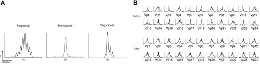 Figure 4. (A) The normal Vβ spectratype pattern consists of 6 to 8 bands and shows a Gaussian distribution in which the density of bands is generally higher in the middle part of the spectratype. Contracted spectratypes consisting of 1 to 4 peaks suggest the presence of a monoclonal (1 dominant peak) or oligoclonal (2-4 peaks) T-cell population. (B) Reversion of the T-cell repertoire to “normal” in an ITP patient after rituximab therapy. Several monoclonal (eg, VB 17, VB 18) or oligoclonal baseline patterns (eg, VB 1, VB 3, VB 5, VB 6, VB 9) turn to polyclonal after the B-cell–depleting therapy. Shown are the CDR3 size length (40 amino acids) in x-axis versus the relative fluorescence intensity in y-axis.