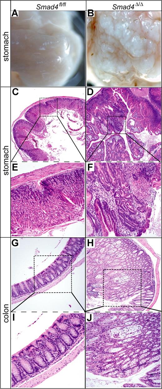 Figure 6. Stomach and colon polyp formation in Smad4Δ/Δ mice. The left panel shows a Smad4fl/fl control mouse, right panel shows a Smad4Δ/Δ mouse. Gross macroscopy of stomach (A,B), histologic hematoxylin-eosin staining of stomach (C-F), and colon (G-J) with magnified view of the boxed areas. Magnifications for A,B: 2.5×; C,D: 50×; E-H: 100×; I,J: 200×.