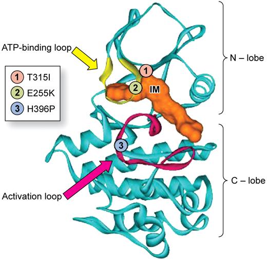 Figure 1. Abl protein with the activation loop in the closed configurations showing the manner in which imatinib (marked IM) occupies the ATP-binding site (also known as the phosphate- or P-loop). Note also the relative position of 3 of the more commonly mutated residues: (1) T315I in the gateway position, (2) E255K in the P-loop, and (3) H396P in the activation loop. Adapted with permission from Deininger et al.5 © The American Society of Hematology.