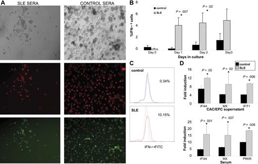 Figure 4. Increased IFN-α expression in lupus EPCs/CACs. (A) Lupus serum prevents monolayer formation by healthy control EPCs/CACs. Control PBMCs were plated on fibronectin-coated wells with complete EC media in the presence or absence of 20% allogeneic control or SLE sera. At day 15, EC monolayer formation was assessed. Images are representative of 7 of 8 SLE serum samples and 4 of 4 control serum samples used in 5 allogeneic control PBMCs. Images represent bright field (top), diI–ac-LDL (middle), and UEA-1–FITC (bottom) of allogeneic control cells exposed to 1 representative SLE serum sample (left) and 1 representative control serum sample (right; × 10 objective magnification). See “In vitro differentiation into mature ECs” for more image acquisition information. (B) Graphs represent percentage IFN-α expression (± SEM) of 13 SLE and 6 controls in PBMCs cultured under proangiogenic conditions. (C) IFN-α expression on day 1–cultured cells of a representative control and SLE patient. (D) EPC/CAC supernatants and autologous serum from SLE patients induce higher expression of IFN-α–inducible genes in epithelial cell lines than controls. Results represent fold induction of IFN-inducible genes (mRNA) and are presented as mean (± SEM) of supernatants or sera from 8 controls and 23 SLE patients. Data are normalized to HPRT-1.