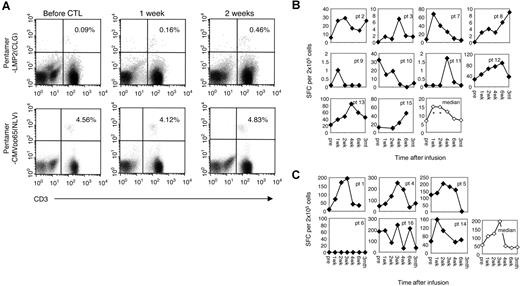 Figure 2. The frequency of LMP2-specific T cells increased after infusion of polyclonal LMP2-specific CTLs. LMP2 multimer analysis was also used to compare the frequency of LMP2-specific CTLs before and after infusion. The average number of LMP2 and CMV multimer-reactive cells per 106 CD8+ T cells are shown for 1 patient before and after infusion (A). This patient was representative of the 10 patients who received CTLs where specific LMP2 epitopes had been characterized. In these 10 patients in whom the HLA-restricted LMP2 peptide(s) were available, peripheral blood T cells were incubated with LMP2pepmix, and the number of IFN-γ spot-forming cells per 2 × 105 mononuclear cells was measured (B). In the 6 patients in whom LMP2 peptides were not detected, peripheral blood T cells were incubated with autologous LCLs, and the number of IFN-γ spot-forming cells per 2 × 105 mononuclear cells was measured (C).
