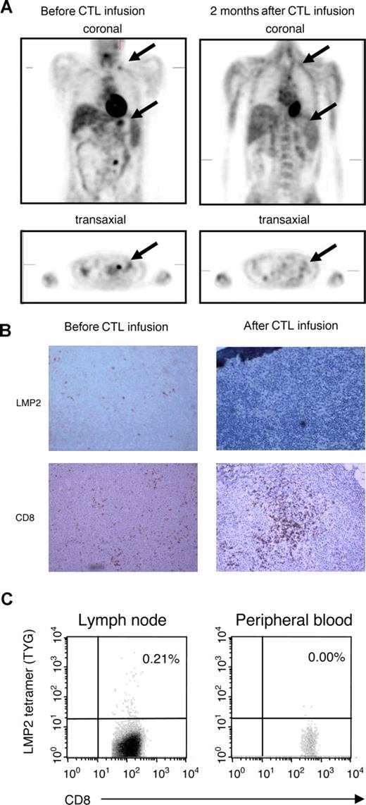 Figure 3. Induction of complete clinical response and LMP2-specific T-cell accumulation at tumor site after CTL infusion. A positron emission tomography (PET) scan demonstrating abnormal fluorodeoxyglucose (FDG) uptake in supraclavicular and para-aortic lymph nodes was observed before CTL infusion in a patient with NHL (pt 2). The follow-up scan 8 weeks after CTL infusion is reported as normal (A). Using immunohistochemistry, CD8+ infiltrating T cells were seen in lymph node biopsy after CTL infusion, which corresponded to a clearance of LMP2+ tumor cells (B). In addition, the percentage CD8+/LMP2 tetramer+ T cells in the lymph node and peripheral blood were compared after CTL infusion by flow cytometry (C). Images were acquired with an Olympus BX41 microscope (OlympusAmerica, Center Valley, PA) with a Plan Achromat 10×/0.25 NA oil objective lens (Olympus, Tokyo, Japan). Cells were stained with hematoxylin (Mayer)-eosin and also with CD8 monoclonal antibody (Dako, Carpinteria, CA) and LMP2 antibody (gift of Dr Friedrich A. Grässer, Institut für Mikrobiologie und Hygiene Abteilung Virologie, Homburg/Saar, Germany) and were used in immunoperoxidase protocol. Images were photographed with an Olympus Q-Color 5 digital color camera using FireWire technology and processed with Adobe Photoshop Elements 2.0 imaging software (Adobe Systems, San Jose, CA). Original magnification, ×10.