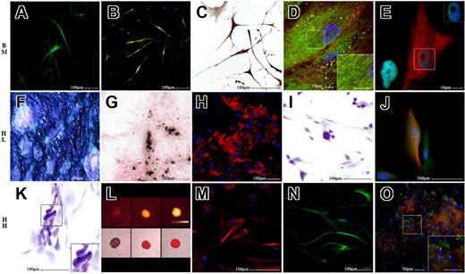 Figure 5. Multilineage differentiation of human single-cell–derived clones. Differentiation of bone marrow (BM)–, liver (HL)– and heart (HH)–derived single-cell clones (SCCs). The top row of figures refers to a BM-derived SCC, the middle row refers to HL-derived SCC, while the bottom row refers to HH-derived SCC. The first 3 pictures of each row illustrate multiple demonstrations of the differentiation into an ectodermic derivative (neurons, top row), a mesodermic derivative (osteoblasts, middle row), and an endodermic derivative (hepatocytes, bottom row). The last 2 pictures of each row demonstrate that each clone was also able to differentiate into derivatives of the other 2 germ layers. Specifically, panel A illustrates beta3 tubulin staining in green (A488), and panel B demonstrates tyrosine hydroxylase staining in yellow (A488). Panel C demonstrates a positive immunohistochemistry staining for acetylcholine transferase. Panel D shows α-actinin (A555, red fluorescence) and ryanodine receptor (BODIPY, green fluorescence) stainings; the insert box shows at higher magnification interdigitating α-actinin and ryanodine receptor positivities. Panel E illustrates GATA4 (A488, green fluorescence in nuclei) and cytokeratin (A555, red fluorescence) labeling; the insert box documents that cytokeratin-positive cells are also GATA4 positive. Panel F reveals a positive cytochemical reaction for alkaline phosphatase activity. Panel G documents a positive von Kossa cytochemical reaction. Panel H shows the red fluorescence of tetracyclines incorporated in calcification sites. Panel I shows in purple a positive PAS reaction. Panel J documents in green GFAP (A488) and in red beta3 tubulin–positive cells (A555). Panel K reveals PAS positivity of differentiated cells. Panel L shows, in the top row, in pseudocolors (Q-LUT, scale bar) resorufin fluorescence of cell aggregates exposed to pentoxyresorufin (PR), and in the bottom row, overlay of phase contrast and red fluorescence images of the same cells; from the left to the right are depicted the following: negative control, cells exposed to PR only, and cells exposed to phenobarbital and PR. Panel M illustrates cytokeratin staining (A555, red fluorescence). Panel N shows beta3 tubulin staining in green (A488). Panel O shows von Willebrand factor in green (A488) and DiI-labeled acetylated LDL in red; insert box is a higher magnification of the marked field. DAPI was used in all fluorescence images to label nuclei in blue. (E,J,L,M) Epifluorescence and phase contrast images obtained using a live cell imaging dedicated system consisting of a Leica DMI 6000B microscope connected to a Leica DFC350FX camera (Leica Microsystems), equipped with a 63× immersion oil (numeric aperture: 1.4; E), a 40× dry (numeric aperture: 0.6; J,M), and a 10× dry (numeric aperture: 0.25; L) objective. (B,D,H,N,O) Image acquisition was carried out by a confocal laser microscope (Leica TCS-SP2), using a 63× immersion oil objective (numeric aperture: 1.40; D) and a 20× dry objectives (numeric aperture: 0.50; A,B,H,N,O). (C,F,G,I,K) Bright field images were captured using an Olympus AX70 microscope connected to an Olympus DP50 camera (Olympus, Italy). A 20× dry objective (numeric aperture: 0.70; F,G) and a 40× dry objective (numeric aperture: 0.95; C,I,K) were used for this purpose. Color temperature: 5400°K. Adobe Photoshop software was used to compose, overlay the images and to adjust contrast (Adobe).