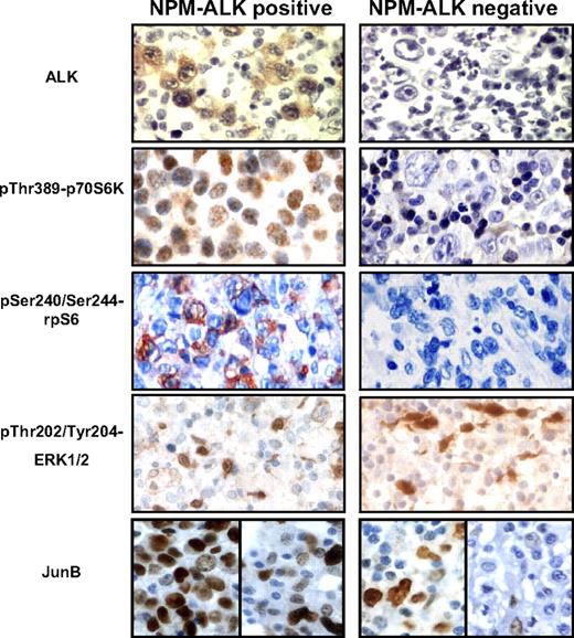 Figure 4. Activation of mTOR and ERK in NPM-ALK–positive ALCL patient samples. Immunohistochemistry of ALCL samples using antibodies against (phospho-) proteins indicated on the left. Representative images from 9 NPM-ALK–positive ALCL (left) and 14 NPM-ALK–negative ALCL (right) patient samples. ALK antibody staining demonstrates expression of NPM-ALK in ALCL cells. JunB antibody staining is shown as minimum and maximum signal intensities of NPM-ALK–positive (left) and NPM-ALK–negative samples (right). See “Immunohistochemistry” for image acquisition information.