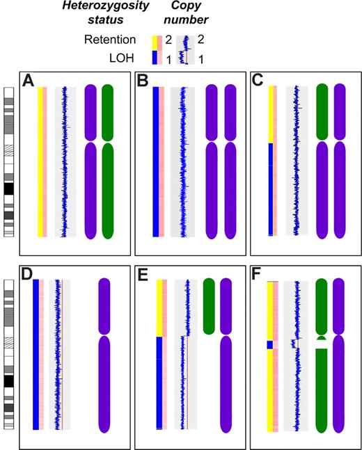 Figure 2. Patterns of LOH on chromosome 16. The first bar in each panel indicates LOH status with retention of heterozygosity (yellow) and LOH (blue). The second bar in each panel indicates copy number with dark pink indicating normal diploid copy number and pale pink indicating deletion. The blue line indicates copy number relative to the red line (copy number of 2) with a line to the left indicating deletion. The chromosome graphics are representations of each inherited chromosome (purple and green). (A) The normal diploid situation. (B) Acquired UPD of the entire chromosome 16 in 2 cases. (C) Acquired UPD of 16q in 2 cases. (D) Deletion of the entire chromosome 16 in 2 cases. (E) Deletion of 16q in 10 cases. (F) Interstitial deletion of varying regions of 16q in 7 cases.