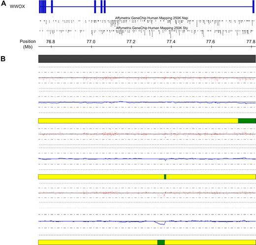 Figure 5. Deletions within WWOX in cases with a t(14;16). (A) Schematic of the WWOX gene located at FRA16D at 16q23. Vertical blue bars indicate exons. The location of the SNPs within the gene on each of the 2 mapping arrays are indicated below the schematic. (B) High-resolution view of the WWOX gene at 16q23. Copy number for each of the 3 t(14;16) samples is indicated below the physical position bar (top). Red dots indicate raw copy number for each SNP. The blue line indicates smoothed copy number. The horizontal bar below each case indicates the presence of normal copy number (yellow) and deletion (green). In all 3 cases, the deletion either commences within WWOX (top case) or lies wholly within WWOX (middle and bottom case), at the presumed translocation breakpoint. The figure was generated using CNAG and the UCSC genome browser.