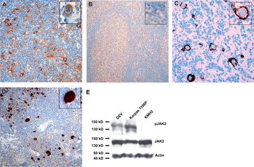 Figure 1. Immunohistochemistry for JAK2 and p-STAT6. IHC for JAK2 with an lpHL case (A) and a tonsil (B) is shown. Inserts show higher magnifications of an L&H cell in panel A and the mantle zone/GC border in panel B. While JAK2 amounts in normal B cells were below the detection limit of IHC, 40 of 47 cases of lpHL showed positivity in L&H cells. (C) IHC with an lpHL case and a p-JAK2 specific antibody is shown. Fractions of L&H cells were positive in 13 of 33 analyzed cases. (D) IHC for p-STAT6 with an lpHL case is shown. Twenty-one of 43 analyzed lpHL cases showed positivity for p-STAT6. All cases were from the files of the Department of Pathology of the University of Frankfurt. Bound antibodies were detected using the Envision system (Dako, Hamburg, Germany) for anti-JAK2 and the CSAII signal amplification system for anti–p-JAK2 and anti–p-STAT6 with horseradish peroxidase and 3.3-diaminobenzidine as substrate. Specificity of antibodies was verified by comparison of IHC with Western blot analysis (JAK2 and p-STAT6; Figures S1,S2) and/or by the use of 2 different antibodies directed against the same antigen (JAK2 and p-JAK2). Specificity of anti–p-JAK2 and anti–p-STAT6 antibody for phosphorylated JAK2 and STAT6 was tested by pretreatment of several cases with T-cell phosphatase,5 which abolished staining completely (Figure S3). (E) Western blot analysis of JAK2 expression and activation in the lpHL-derived cell line DEV is shown. Whereas JAK2 was expressed in the MLBCL-derived cell line Karpas1106P, the cHL-derived cell line KMH2, and DEV, activation of JAK2 was observed only in Karpas1106P and DEV, in line with the presence of SOCS1 mutation only in Karpas1106P and DEV6.