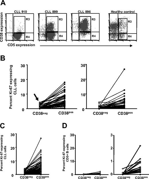 Figure 2. Ki-67 expression by CD38+ and CD38− B cells within individual patients with CLL. PBMCs from 95 patients with CLL and 20 elderly healthy donors were stained as in Figure 1. (A) Dotplots of CD5 and CD38 expression by B cells from 3 patients with CLL and 1 healthy donor. (B) Left panel: Lines connect data points for percentage of Ki-67+ cells in CD38− and CD38+ subsets within each patients with CLL in the CD38low subgroup. Note the detection of Ki-67+ cells even in the CD38− subset of CD38low patients (arrow). Right panel: Lines connect data points for percentage of Ki-67+ cells in CD38− and CD38+ subsets within each CLL clone in the CD38high subgroup. (C) Lines connect data points for percentage of Ki-67+ cells in CD38− and CD38+ subsets of all patients with CLL. (D) Left panel: Lines connect data points for percentage of Ki-67+ cells in CD38− and CD38+ subsets within each healthy participant. Right panel: Same data from left graph drawn to a smaller scale.