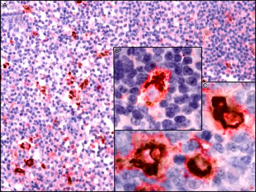 Figure 8. CXCL13 expression in situ by CD68+ macrophages in lymph nodes from CLL patients. Paraffin-embedded sections of lymph nodes from CLL patients were incubation with anti-CD68 and anti-CXCL13 mAbs. For simultaneous detection of CD68 and CXCL13, a biotin-free system was used that is based on peroxidase with DAB as chromogen (brown) for CD68 detection and alkaline phosphatase with permanent red chromogenic substrate for detection of CXCL13. Images were visualized using a Zeiss Axiovert 135 microscope, C-Apochromat objectives, an AxioCam ICc3 camera, and Axioplan 2 imaging software (all from Carl Zeiss, Jena, Germany) and processed using Canvas 9 software (ACD Systems, Victoria, BC). (A) A lymph node section at low magnification (200×) that depicts CD68+ cells scattered throughout the displayed section that coexpress CXCL13. (B,C) Higher magnification that depicts coexpression of CD68 (brown, perinuclear) and CXCL13 (red) at 630×.
