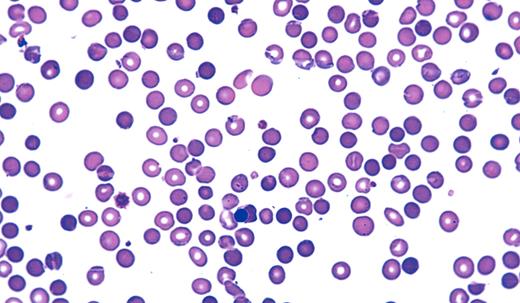 Neil Abramson, Baptist Cancer Institute