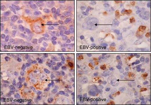Figure 7. Expression of PTPRK in primary HL biopsies. Immunohistochemistry significantly demonstrates the frequent down-regulation of PTPRK expression in HRS cells (→) of EBV-positive cases of HL. Shown is representative staining for 2 EBV-negative cases (left panel) and 2 EBV-positive cases (right panel). Subsets of surrounding lymphoid cells were PTPRK positive and provided an internal positive control. Images were acquired using Nikon TE2000 with 60×/1.4 NA oil-immersion lens (Nikon, Kingston-upon-Thames, United Kingdom). Cells were stained with DAB immunoperoxidase and counterstained with hematoxylin. Images were captured with a Nikon Coolpix 2100, and Paint Shop Pro 8.0 (Jase Software, Maidenhead, United Kingdom).