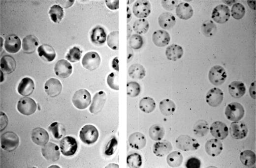 Figure 2. The Heinz body test for primaquine sensitivity (G6PD deficiency). The cells (right) are from a primaquine-sensitive (G6PD-deficient) donor; the cells in the left panel, from a normal control.