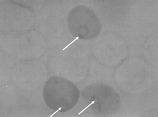 Figure 6. An indirect histochemical stain of erythrocytes from a heterozygote for G6PD deficiency who was suffering from naturally acquired malaria. The more pigmented cells are those that contain normal G6PD activity. They contain the highest percentage of malaria parasites, as shown by the arrows. (Courtesy Professor Lucio Luzzatto.)