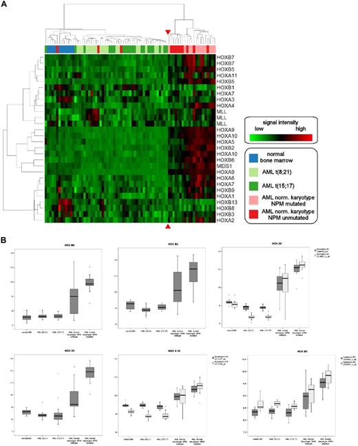 Figure 6. Hierarchic clustering of CDX2-positive AML samples according to HOX gene expression. (A) Unsupervised hierarchic clustering according to HOX gene expression demonstrates HOX gene deregulation in patients with normal karyotype with or without NPM1 mutation compared with samples with abnormal karyotype or normal bone marrow samples. The red arrows highlight the boundary between the 2 main clusters. The genes and samples were permutated. (B) Expression of individual HOX genes in CDX2-positive AML samples with normal and abnormal karyotype. Log expression levels of 6 different HOX genes in 75 clinical samples are shown in box-and-whisker plots. Expression was determined by Affymetrix HGU-133 A and B microarrays. The plots show the normalized expression values in normal BM samples (n = 11), AML with t(8;21) (n = 20), AML with t(15;17) (n = 20), and AML with normal karyotype with (n = 12) and without NPM1 mutation (n = 12). The bar indicates the median expression levels and the box shows the 25th and 75th percentiles, while the whiskers show the maximum and minimum values. Outliers (values that are more than 1.5 interquartile ranges above the 75th or below the 25th percentile) are represented by open circles.