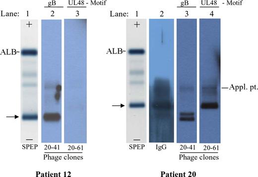 Figure 4. Serum protein electrophoretic analysis and phage immunoblot, patients 12 and 20. The paraproteins are evident on serum protein electrophoresis (SPEP) pattern (lane 1). The anode (positive pole) is toward the top, with albumin (ALB) being the most anodal serum protein visible in the gel. The serum paraprotein is denoted with →. For patient 12 (lefthand gel), lane 2 is probed with phage clone 20-41, which expresses a peptide associated with the AD-2S1 epitope of HCMV glycoprotein B. Lane 3 is an irrelevant phage clone. For patient 20, lanes 2 to 4 are replicates of lane 1, blotted onto a nitrocellulose membrane, and immunostained with various probes. Lane 2 was immunostained with a human IgG-specific antibody conjugate. Lanes 3 and 4 were immunostained with the indicated phage clones, which are also listed in Figure 2. Clone 20-61 is derived from motif 1, containing the UL-48 gene product paraprotein epitope. Sera are undiluted in lane 1, and diluted 1:100 for lanes 2 to 4. Appl pt denotes the gel application point, which sometimes yields a faint artifactual band.