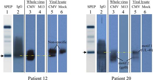 Figure 6. Agarose gel immunoblots, demonstrating the specific paraproteins responsible for immunoreactivity of patients 12 and 20 against HCMV. Patient 12, left; patient 20, right. Lane 1 depicts the serum protein electrophoresis (SPEP) pattern of major serum protein bands, as stained with amido black, without any protein transfer onto nitrocellulose. The image is that of the gel itself. The arrow and yellow dashed line denote the gel position of the serum paraprotein. The images for lanes 2 to 6 were scanned from a photographic film, after exposure to a nitrocellulose membrane. For lane 2, the membrane was probed for the presence of human IgG. For lanes 3 and 4, nitrocellulose membranes were precoated (prior to protein transfer) with inactivated, density-gradient purified HCMV whole virion (lane 3) or the antigenically unrelated M13 virus (lane 4). For lanes 5 and 6, nitrocellulose membranes were precoated with an HCMV lysate (lane 5) or a mock lysate derived from uninfected cells (lane 6). Each patient's image therefore represents a composite. For patient 12, the nonspecific band that is present in both the HCMV lysate lane (lane 5) and mock lysate lane (lane 6) does not comigrate with the paraprotein (lane 1, ).