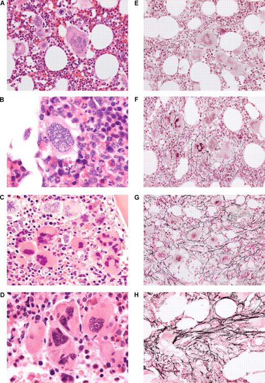 Figure 1. Examples of morphologic features scored on 370 diagnostic bone marrow trephine specimens from patients enrolled in prospective clinical trials of ET. (A) H&E-stained section (×400 magnification) showing a large, staghorn megakaryocyte in the center of the field. (B) H&E-stained section (×1000) showing a cloudlike megakaryocyte in a background of with increased cellularity. (C) A loose cluster of megakaryocytes showing other marrow cells between individual megakaryocytes (H&E stain ×400). (D) A tight cluster of megakaryocytes (H&E stain ×1000) showing molding of the juxtaposed cell surfaces between adjacent megakaryocytes, and no intervening marrow cells. (E-H) Reticulin stains (all ×400) showing increasing reticulin, graded 1 to 4, respectively.