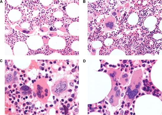 Figure 2. Trephine histology showing morphologic features that suggest different WHO diagnoses in the same medium- (×400) or high-power (×1000) field. (A) Pyknotic megakaryocytes (indicative of myelofibrosis) in a field otherwise suggestive of true ET (normal cellularity, loose megakaryocyte cluster). (B) Staghorn megakaryocytes in a loose cluster (characteristic of true ET) in a hypercellular marrow (suggesting prefibrotic myelofibrosis). (C) Staghorn megakaryocyte (true ET) immediately adjacent to a cloudlike megakaryocyte (prefibrotic myelofibrosis). (D) Staghorn megakaryocyte (true ET) in a tight cluster (prefibrotic myelofibrosis).