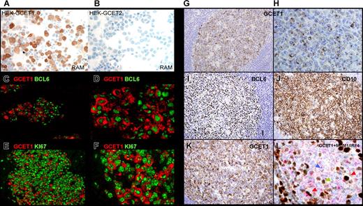 Figure 2. Gcet1 validation and characterization in reactive lymphoid follicles. (A,B) Cytospin slides of transfected HEK cells. The transfected HEK cell line with GCET1-cDNA showed a specific staining with Gcet1 mAB. However, the same line with GCET2-cDNA was negative with Gcet1 mAB. (C-F) Double immunofluorescence combined with enzymatic staining in reactive follicles. Gcet1 was found to be expressed in a relatively large proportion of BCL6-positive cells, whereas few BCL6-positive cells were negative with Gcet1 (C,D). Double immunostaining for both Ki67 and Gcet1 demonstrated that all Gcet1+ cells were double-positive with Ki-67, whereas some Ki67-positive cells were negative with Gcet1 (E,F). (G,H) Immunostaining of a reactive follicle with anti-Gcet1 mAb. Gcet1 expression was restricted to germinal center B cells. Granular cytoplasmic staining was observed in centroblasts (large noncleaved cells) and large centrocytes (large cleaved cells) but not in small centrocytes (small cleaved cells). (I-K) The same GC is shown with Bcl6, CD10, and Gcet1 Abs for comparison. Gcet1 mAb had a heterogeneous staining pattern, selecting a subpopulation of Bcl6-CD10 double-positive cells. (L) Double immunoenzymatic staining with Gcet1 (red) and MUM-1/IRF4 (brown) demonstrated a small population of Gcet1-MUM1/IRF4 double-positive cells (red arrows). Blue and green show Gcet1-only or MUM1/IRF4-only positive cells. respectively.