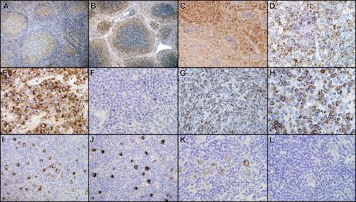Figure 4. Gcet1 immunohistochemical expression in major lymphoma subtypes. (A-D) Gcet1 expression in follicular lymphoma. Gcet1+ cells were found in the germinal center (A), also in areas of marginal zone differentiation (B), and diffuse areas (C). At higher magnification (D), the diffuse and heterogeneous staining of the neoplastic population. (E,F) Gcet expression in Burkitt lymphoma. In BL-positive cases, the staining was diffuse, with the characteristic cytoplasmic localization (E). However, some BL cases were negative (F). (G,H) Gcet1 expression in DLBCL. (I) Gcet1 expression in T/HRBCL. In positive cases, Gcet1 selectively stained the tumoral B cells. The pattern of staining was similar to that found in NLPHL (J) and in positive cases of LRCHL (K). However, a subgroup of LRCHL (L) and all the other classic HL subtypes remained negative for Gcet1.