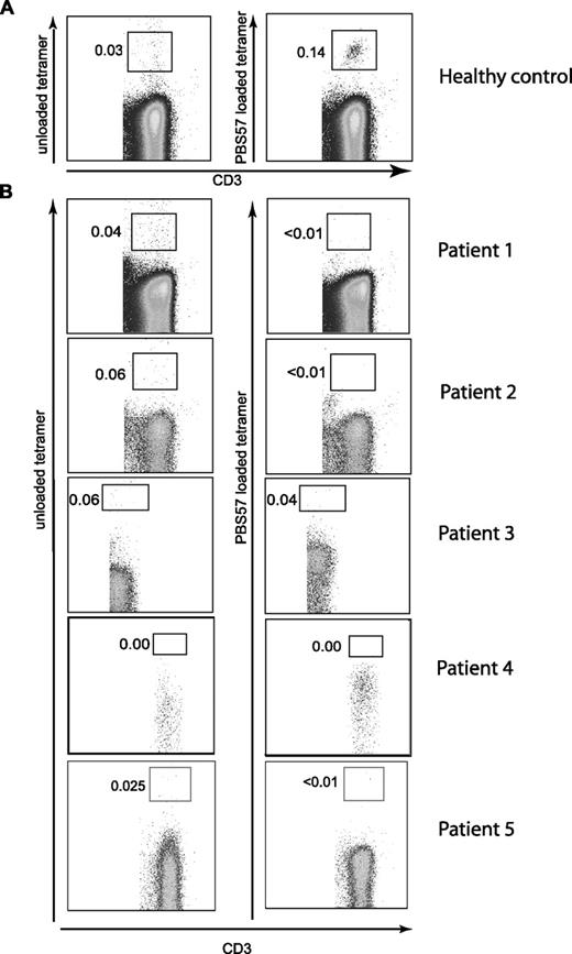 Figure 1. Flow cytometric analysis of peripheral blood iNKT cells from patients with hypomorphic RAG mutations. Mononuclear cells (PBMCs) from a healthy control (representative of 6 donors) (A) and 5 patients with hypomorphic mutations of the RAG genes (B) were analyzed for the presence of iNKT cells. Leukocytes were enumerated by gating on CD45+CD3+ cells. iNKT cells were identified using PBS57-loaded CD1d tetramers (right) using cells stained with unloaded CD1d tetramers as control (left).