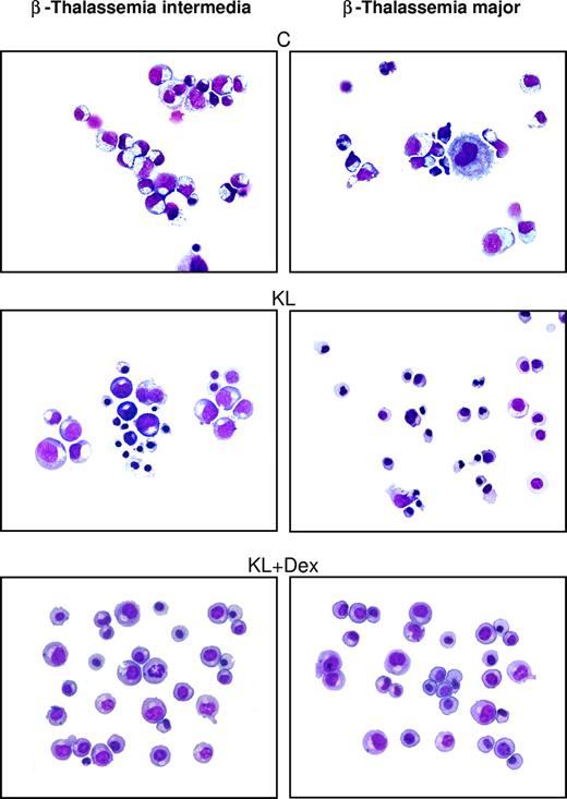 Figure 3. Morphologic cell features in β-thalassemic erythropoiesis. Morphology of erythroid cells generated in HPC unilineage erythroid cultures from one representative β-TI patient (left panels) and one representative β-TM patient (right panels), supplemented or not with KL and KL plus Dex. Cytocentrifuged cells have been stained with May-Grünwald Giemsa and then analyzed by an Eclipse 1000 optical microscope (Nikon, Tokyo, Japan; 400×/1.30 NA 40× objective). Images were acquired with a Nikon DXM 1200 camera using ACT-1 software (Nikon).