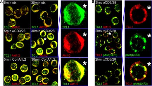 Figure 3. TCL1 and AKT are recruited to membrane complexes following TCR engagement. (A) Laser confocal microscopy on unstimulated primary T-PLL cultures showed a predominantly cytoplasmic distribution of TCL1 and AKT without apparent colocalization (ctr, top panel); only rare “activated” cells show TCL1-AKT colocalization. TCR engagement using anti-CD3/28 precoated plates leads to rapid focal recruitment along with colocalization of TCL1 and AKT in a uniform perimembraneous pattern (middle panel), which was also seen with ConA/IL2 stimulation (bottom panel). (B) Continuous TCR engagement in sTCR+/sCD3+ T-PLL shifted localization of TCL1 to discrete membrane complexes that also included pAKT-S473 and LCK. Staining was done using anti-TCL1 (FITC: green) in combination with anti-AKT1/2 or anti-LCK (Cy3: red), or a TCL1 antiserum (Cy3: red) with a monoclonal anti–pAKT-S473 (FITC: green). Merged pictures are shown for low-power fields; asterisk indicates location of cell shown in enlarged panels for individual fluorochromes and merged image.