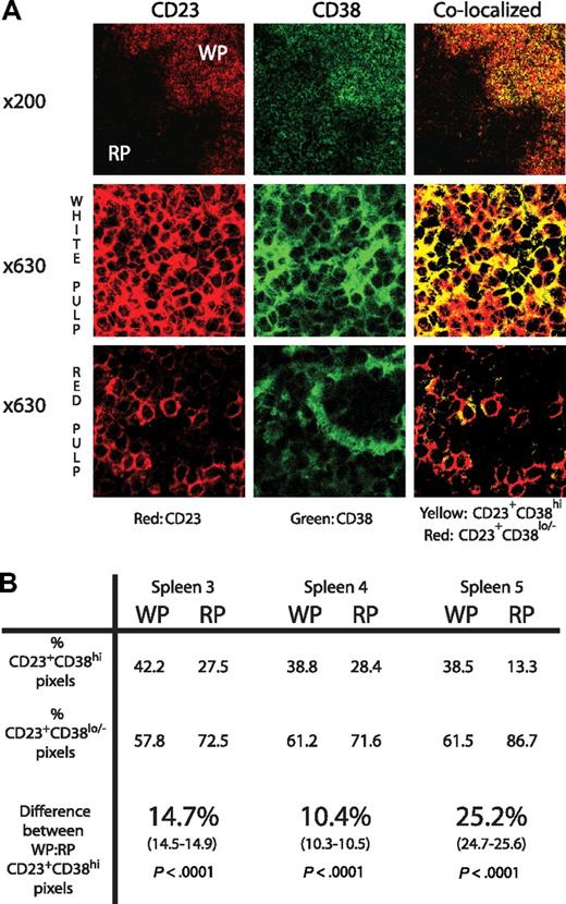 Figure 1. CD38 expression is higher on CLL cells derived from splenic white pulp compared with splenic red pulp. (A) Sections of spleen stained for CD23 (shown in red) and CD38 (shown in green) at ×200 and ×630 original magnifications. In the colocalized images, yellow represents CD23+CD38hi and red represents CD23+CD38lo/− pixels. Although the ×200 views show that CD38 staining is apparent in both red and white pulp, the high-power views show that CD38 colocalizes with CD23+ tumor in the white pulp areas, whereas in the red pulp it does not and must be expressed by cells other than the tumor. (B) The table shows the percentage of CD23+CD38hi and CD23+CD38lo/− pixels in both white pulp (WP) and red pulp (RP) in sections of the 3 available spleens with high CD38 staining detectable in the white pulp. CD38 expression by the tumor cells is at least 10% greater in the WP compared with the RP (95% confidence interval shown in brackets). Significance was demonstrated using the χ2 test.