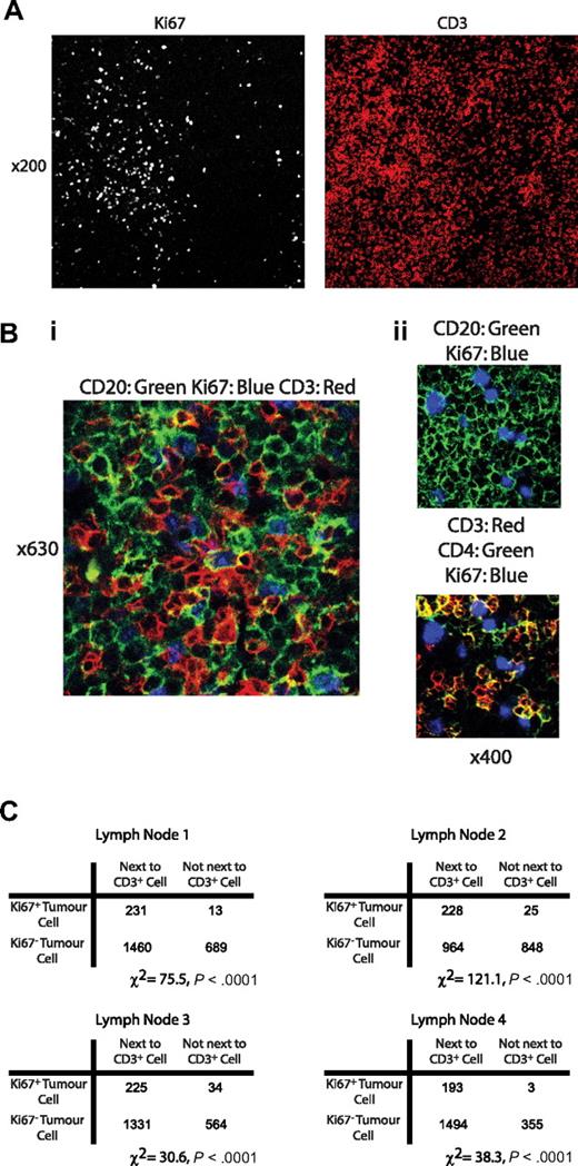 Figure 5. Large Ki-67+ tumor cells are present in lymph node sections and are found in close proximity to CD+ T cells. Confocal immunofluorescence microscopy of CLL lymph nodes. (A) View (original magnification ×200) of a CLL lymph node stained with Ki-67 and CD3. Ki-67+ cells were confirmed to be CLL cells using costaining with CD20 (data not shown). In this example, Ki-67+CD20+ cells had a patchy distribution. In areas of high Ki-67, staining with CD3 showed these areas also had a higher density of T cells. (Bi) View (original magnification ×630) of an area rich in proliferating CLL cells stained with CD20, Ki-67, and CD3. CD3+ cells are shown to be in intimate contact with Ki-67+ tumor cells. (Bii) View (original magnification ×400) of an area of lymph node stained with CD20 (green), CD3 (red), CD4 (green), and Ki-67 (blue). The CD3+ cells adjacent to CD20+Ki-67+ tumor cells show colocalization with CD4 (yellow). In all sections examined, more than 80% of these CD3+ cells colocalized with CD4. (C) Quantitative assessment of the spatial relationship between Ki-67+ tumor cells and CD3+ cells in serial views of 4 separate lymph node specimens confirms that proliferating tumor cells are significantly more probable to be touching an adjacent T cell compared with Ki-67− cells in all cases (χ2 test).