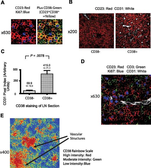 Figure 6. Relationship of lymph node CD38 expression with tumor proliferation and the microvasculature. (A) View (original magnification ×630) of a CLL lymph node from a patient with a peripheral blood CD38 level of 13% stained with CD38 (green), Ki-67 (blue), and CD23 (red). All proliferating CLL cells stain for both CD23 and CD38 (yellow). Identical appearances were observed in all CD38+ lymph nodes, defined by the presence of detectable CD38 staining as detailed in “Distribution of CD38 expression in CLL lymph nodes.” (B) View (original magnification ×200) of a CLL lymph node stained with CD31 (white) and CD23 (red), illustrating the larger number of vessels in a CD38+ compared with a CD38− case. (C) Quantification of the difference in lymph node vascular density assessed by the number of CD31+ pixels in CD38− and CD38+ cases of CLL. Significantly increased vessel density is apparent in the CD38+ cases. Results shown are the mean CD31 pixel index plus or minus SEM with the unpaired t test result. (D) View (original magnification ×630) of a CD38+ CLL lymph node, illustrating the relationship between proliferating CLL cells stained for Ki-67 (blue) and CD23 (red), T cells stained for CD3 (green), and a microvessel detected by CD31 (white). (E) View (original magnification ×400) of a CLL lymph node frozen section stained for CD38 and shown as a rainbow palette image in which different levels of expression are assigned a different color. The level of CD38 expression varies markedly within the lymph node and is most dense in areas around vascular structures. This image is representative of 12 frozen sections.