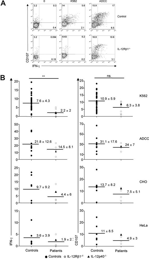 Figure 2. NK cell hyporesponsiveness in IL-12/23 axis–deficient patients. (A) A representative experiment comparing the in vitro reactivity of NK cells from healthy control individuals and IL-12Rβ1–deficient patients is shown. PBMCs were incubated for 4 hours in the presence or absence of K562 cells and assessed for CD107 and IFN-γ expression. (B) PBMCs prepared from a cohort of healthy control individuals, IL-12Rβ1–deficient patients and one IL-12p40–deficient patient were analyzed for their NK reactivity in the presence of indicated tumor cells; ADCC: antibody-coated P815 cells. Values indicate mean plus or minus SD. Each dot represents the data obtained from one individual.