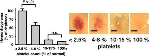Figure 4. Rescue of inflammatory hemorrhage by minor platelet transfusion. The rpA model was studied in thrombocytopenic mice receiving transfusion of depletion-resistant platelets from IL4Rα/GPIbα-tg mice. Bars indicate the area of hemorrhage in mice at various platelet counts. Photographs (right) show representative rpA reaction spots. Bar = 5 mm. Transfusion of platelets to 5% to 8% of normal platelet count significantly prevented bleeding (P < .01). At levels of 10% to 15% circulating platelets, the hemorrhagic area was similar to nondepleted control mice (P = .15; n = 5). Error bars represent SEM.