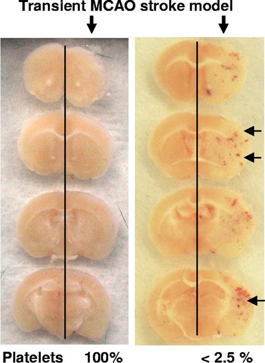 Figure 5. Inflammatory hemorrhage in stroke. Brain sections of mice challenged by the middle cerebral artery occlusion stroke model and analyzed 24 hours after reperfusion. The inflamed hemisphere (right) shows hemorrhagic spots in the thrombocytopenic mice ().