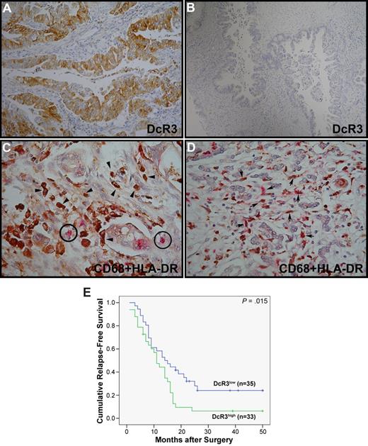 Figure 3. Expression of MHC-II molecules in TAMs from pancreatic cancers. DcR3 expression in human pancreatic cancers was visualized by immunohistochemistry (IHC) staining using anti-DcR3 mAb and the ultra-View Universal DAB detection kit (A,B). Double staining of CD68 (brown) and HLA-DR (pink) was performed with the Ventana iVIEW DAB and the Enhanced V-Red detection kit, respectively (C-D). Circled cells correspond to small lymphocytes as an HLA-DR–positive control, arrowheads indicate HLA-DR–negative TAMs (strong brown color) in DcR3high sample (C), and arrows point to HLA-DR–positive TAMs (weak brown color interdispersed with pink color) in DcR3low sample (D) (magnification 10 × 60). (E) Effects of DcR3 expression on the relapse-free survival of pancreatic cancer patients. Kaplan-Meier survival curves are shown for patients from DcR3high (3+ and 2+) and DcR3low (1+ and 0) groups in green and blue, respectively.