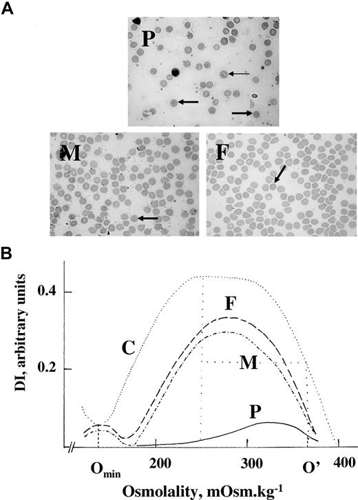 Figure 1. Blood smears and osmotic gradient ektacytometry. Blood smears (A) and osmotic gradient ektacytometry (B). (A) P indicates proband. Many red blood cells were spherocytes (➡). The remaining showed further changes, as if some fragmentation had occurred. There was a pronounced anisocytosis. A few red cells verged on stomatocytes (→). Erythroblasts were present (17%). F indicates father. Presence of many spherocytes without anisocytosis. M indicates mother. Presence of many spherocytes without anisocytosis. (B) In both parents (M and F), there was an increased osmotic fragility, a reduced maximum deformability index, and a decreased dehydration, a situation typical of HS.11 These features were dramatically enhanced in the proband (P). C indicates control. The maximum deformability index (DImax; normal values, 0.41-0.53 AU) is the maximum value of the deformability index. The “hypo-osmotic point” (Omin; normal values, 143-163 mOsm/L) is the osmolality at which the deformability index reaches a minimum in the hypotonic region; it is the same as the osmolality at which 50% of the erythrocytes hemolyze in a standard osmotic resistance test. This index thus provides a measure of the average surface area–to-volume ratio of erythrocytes. The “hyper-osmotic point” (O′; normal values, 325-375 mOsm/L) is the osmolality in the hypertonic region (right leg of the curve) at which the deformability index reaches half its maximum value. It provides information on the erythrocyte hydration.