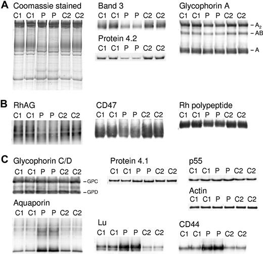 Figure 2. Coomassie and immunostaining of erythrocyte membrane proteins. Erythrocyte membranes were separated on 10% Laemmli gels and immunoblotted using antibodies as shown. Loading C1, C2, controls 1 and 2, respectively. P indicates proband. (A) Proteins of the band 3 complex: immunoblotting used the monoclonal antibody BRIC170 (N-terminal band 3) and antipeptide antibodies against C-terminal of protein 4.2 and GPA. (B) Proteins of the Rh complex: immunoblotting used antipeptide antibodies against C-terminal of RhAG, Rh polypeptides, and CD47. (C) Proteins of the glycophorin C (GPC) complex: immunoblotting used antipeptide antibodies against C-terminal of GPC and GPD, protein 4.1, and p55. Other proteins: immunoblotting used monoclonal antibodies anti–β-actin (Abcam), BRIC235 (CD44), and BRIC221 (Lu), and an antipeptide antibody against C-terminal aquaporin (AQP1). All antibodies used as described in “Erythrocyte membrane protein analysis.”