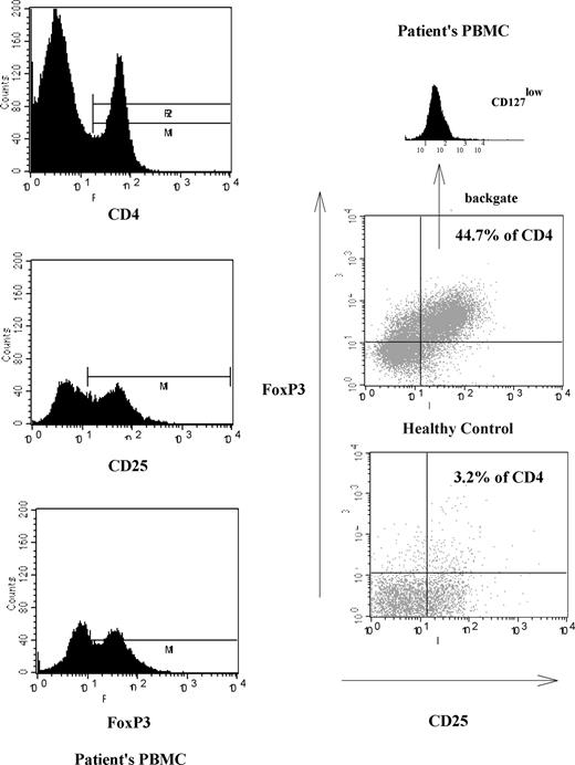 Figure 1. Illustration of increased numbers of CD25+ Treg cells in one representative NHL patient. The 3 left-hand panels illustrate the gating strategy used to distinguish CD25+ Treg cells. The main panels on the right show representative FACS analyses demonstrating CD25+CD127lowFoxP3 Treg cell percentage in patient's PBMCs and comparison with a healthy control.