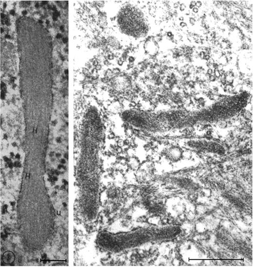 Figure 2. Weibel-Palade bodies are endothelial-specific organelles that store von Willebrand factor. (Left) Oblique section of a Weibel-Palade body from pulmonary artery endothelium of a rat, showing parallel arrangement of internal tubules (H). Reproduced with permission from Weibel and Palade.11 (Right) Electron micrograph (Wagner et al12) of human umbilical vein endothelial cells stained for von Willebrand factor with peroxidase showing a cluster of positively stained Weibel-Palade bodies. Left bar is 0.1 μM, and right bar is 0.5 μM. Reproduced from The Journal of Cell Biology.11,12 Copyright 1964 and 1982 The Rockefeller University Press.