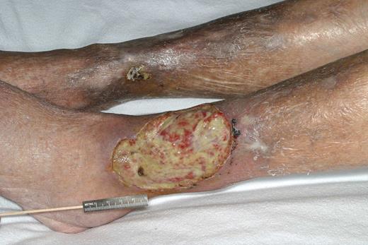 Vasculitic ulcer in a patient with type II cryoglobulinemia. Reproduced from American Journal of Hematology, Vol. 77, No. 4, 2004, pages 329-330. Copyright 2004 Wiley-Liss, Inc. Reprinted with permission of Wiley-Liss, Inc, a subsidiary of John Wiley & Sons Inc.
