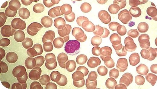 A 28-year-old woman with Hodgkin disease was about to begin her final course of chemotherapy when afternoon fevers, nausea, lethargy, and mild dyspnea developed. During previous treatments, her adenopathy and hepatomegaly resolved and chest x-rays showed a disappearance of the mediastinal mass. Along with the development of new symptoms, she had tender nodes in the neck and axilla. There were no new medications and no contact with people who were ill. Her cat had been in her house for several years. Complete blood count showed a mild anemia, normal platelets, and mild leukocytosis. The absolute lymphocyte count was 8.2 × 109/L (blood smear shown). Prior to an extensive reassessment for a presumed relapse of Hodgkin disease, laboratory tests were ordered for connective tissue diseases, thyroid disorders, viral infections including HIV, and serologic tests for toxoplasmosis. The toxoplasmosis test was IgM positive with a low titer positive IgG. When retested 2 weeks later, along with the first specimen, IgM was still positive and the IgG titers had significantly increased. Chemotherapy was held and she was placed on antibiotics. / Atypical lymphocytes can be found in viral and protozoal infections. Toxoplasmosis may develop in immunocompromised hosts, such as Hodgkin disease, as a new infection or from reactivation of latent toxoplasmosis.