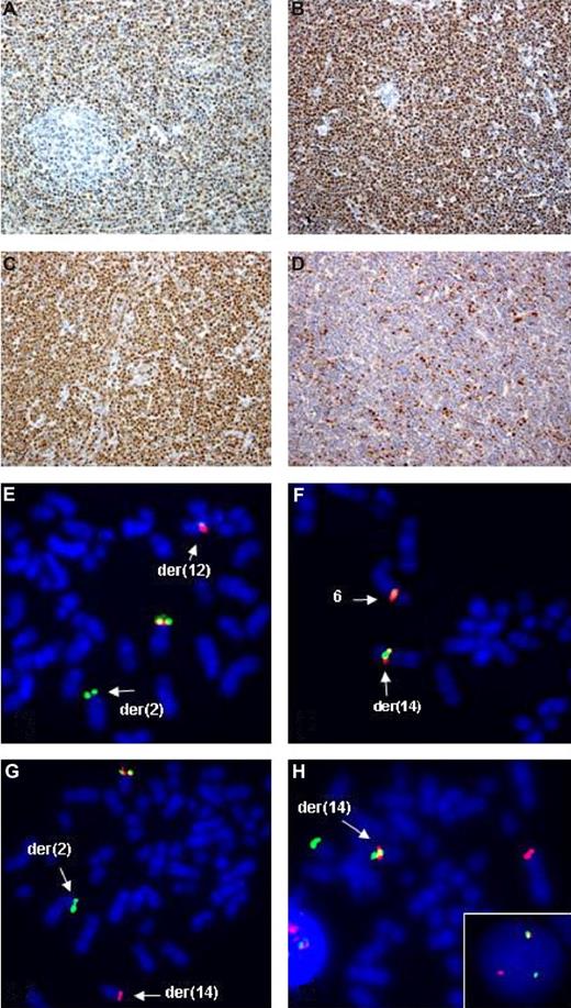 Figure 1. Examples of IHC and FISH analysis on t(11;14)-negative MCL. Upper panels show IHC findings in cases 2 (A), 3 (B), 6 (C), and 8 (D) using antibodies against cyclin D1, D2, D3, and cyclin E, respectively. Note a t(11;14)-independent expression of cyclin D1 in case 2 (A), expression of cyclin D2 in case 3 with a t(2;12)(p11;p13)IGK/CCND2 rearrangement (B), expression of cyclin D3 in case 6 with a t(6;14)(p21;q32)IGH/CCND3 aberration (C), and expression of cyclin E in case 8 negative for D-type cyclins. Lower panels are examples of FISH performed in cases 3 (E), 6 (F), 7 (H, inset) and 8 (G,H). Applied probes were CCND2 break-apart (E), CCND3 break-apart (F), LSI IGH (G), and 3′IGH (SpectrumGreen)/LSI N-MYC (SpectrumOrange) (H). Note a split of signals from probes flanking CCND2 in case 3 (E), translocation of CCND3 on a der(14q) in case 6 (F), split of LSI IGH signals heralding a cryptic t(2;14)(p24;q32) in case 8 (G), a fusion (red LSI N-MYC/2p24 and green 3′IGH/14q32) signal on a der(14) in case 8 with t(2;14) (H), and the same FISH pattern detected in interphase cells from case 7 (H, inset).