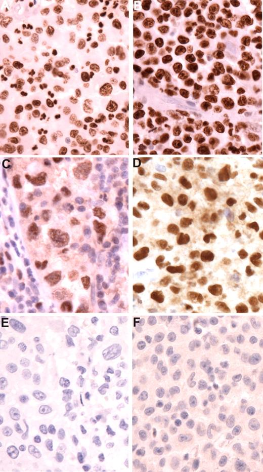 Figure 1. Transcription factor expression in histiocytic sarcomas. (A,B) Staining for CEBP beta in cases 5 and 1. Tumor cells show strong nuclear expression. Note negative blood vessel in panel B. (C,D) Staining for PU.1 in cases 4 and 1. Neoplastic cells (C) show sinusoidal localization. Note negative adjacent lymphocytes. Histiocytic cells have pleomorphic nuclei and prominent nucleoli. (E,F) Staining for PAX5 in cases 8 and 1. No nuclear staining is observed. Follicular lymphomas demonstrated normal expression of PAX5 (not shown). Original magnification for all figures ×400 (hematoxylin counterstain).