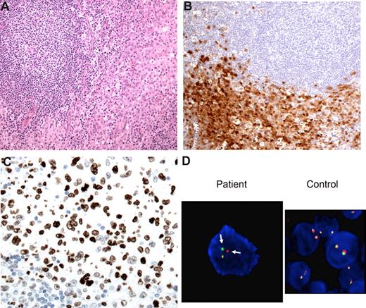 Figure 2. Case 4: synchronous FL and interdigitating cell sarcoma (IDCS). (A) An inguinal lymph node biopsy showed both FL, grade 1, and IDCS. The latter process occupied the majority of the lymph node biopsy, with only focal areas of FL. Magnification ×200. (B) The IDCS showed strong staining for S100 protein. Magnification ×200. (C) Cells of IDCS showed nuclear staining for CEBP beta, negative in FL lymphocytes. Magnification ×400. (D) The IDCS showed splitting of the BCL2 signals (arrow), consistent with presence of the t(14;18), using a breakapart fluorescence in situ hybridization (FISH) probe. A control sample shows no splitting of the BCL2 signals. Magnification ×1250.