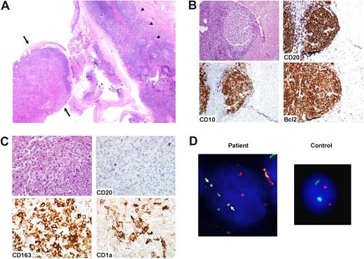 Figure 3. Case 7: synchronous FL and histiocytic sarcoma with dendritic cell differentiation. (A) A mass in the tongue and neck showed both FL, grade 1, and H/DC sarcoma. The FL was associated with lingual lymphoid tissue (arrowheads), while the H/DC neoplasm was associated with the epithelium (arrows). Magnification ×20. (B) The FL was positive for CD20, CD10, and Bcl2. Magnification ×200. (C) The H/DC was positive for CD163 and focally for CD1a, as well as CD68 and S100 (not shown). There was no evidence of infiltrating FL cells, as shown in the CD20 stain. Magnification ×400. (D) The H/DC neoplasm showed fusion of the BCL2 and IGH signals (arrows), consistent with presence of the t(14;18), using dual-fusion FISH (D-FISH) probes. A control sample shows no fusion. Magnification ×1250.