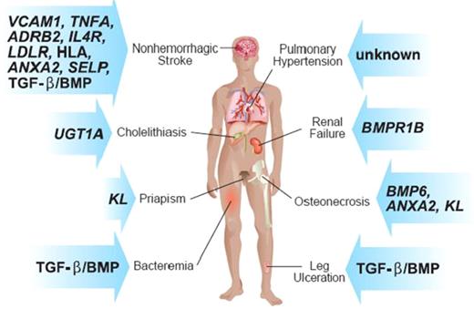 Some of the subphenotypes of sickle cell anemia and the genes in which SNPs have been associated with these phenotypes.