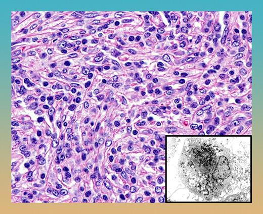 Follicular dendritic-cell sarcoma with syncytial proliferation of spindle cells. Note the characteristic sprinkling of lymphocytes within the tumor. The inset shows the ultrastructural appearance of dendritic cells with villous cell processes and prominent lysosomal granules.