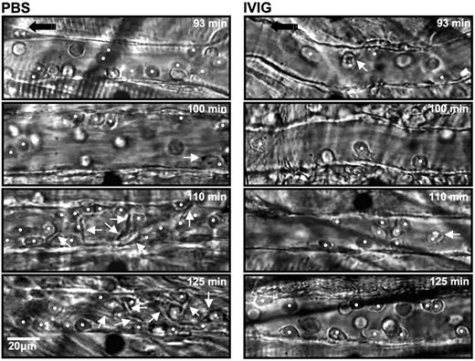 Figure 2. Sequential representative images of venules from sickle mice treated with PBS and IVIG. Each still frame was taken at 93-, 100-, 110-, and 125-minute time points after TNF-α injection. IVIG significantly reduced the number of adherent leukocytes (white circles) and RBCs interacting with adherent leukocytes (white arrows). indicates the direction of flow.