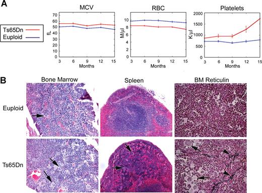 Figure 1. Ts65Dn mice develop megakaryocytic myeloproliferative disease. (A) Complete blood counts (CBCs) are altered in Ts65Dn peripheral blood in comparison with euploid littermate controls. MCV indicates mean corpuscular volume; RBC, red blood cells. n = 14 Ts65Dn; n = 22 euploid same sex littermates. P < .05 for all parameters at all time points. Complete actual values and statistics are provided in Table S2. Error bars represent SE. (B) Hematoxylin and eosin staining of bone marrow and spleen sections (left and middle panels, respectively) highlight megakaryocyte hyperplasia in Ts65Dn animals, while reticulin staining reveals bone marrow fibrosis (right panels). indicate megakaryocytes; indicate reticulin fibrosis. All images were captured at 200× original magnification.
