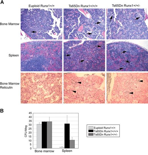 Figure 6. Three alleles of Aml1/Runx1 are not essential for the development of MPD. (A) Hematoxylin and eosin staining of bone marrow and spleen (top 2 panels) and bone marrow reticulin staining (bottom panels) demonstrate that Ts65Dn mice with 3 or 2 alleles of Runx1 (Ts65Dn/Runx1+/+/+ and Ts65Dn/Runx1+/+/−, respectively) develop a similar phenotype. (B) In vitro colony-forming assays demonstrate that restoring disomy at the Runx1 locus does not abrogate extramedullary hematopoiesis in Ts65Dn. Runx1 trisomy may contribute to the extent of extramedullary megakaryopoiesis. Error bars represent SE.
